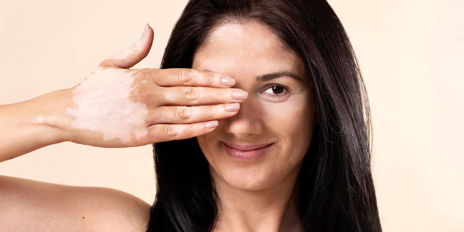 Vitiligo Camouflage Result
